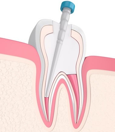 Pediatric Pulp Therapy